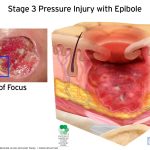 Cross section of skin with open, stage 3 pressure wound, and curled-under edges called epibole